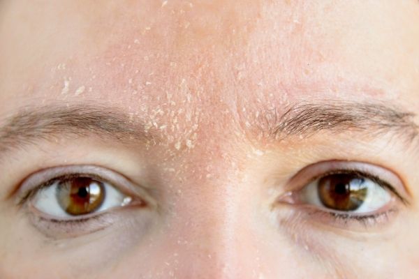 Suva i dehidrirana koža se neguju drugačije. Kakva je tvoja koža?